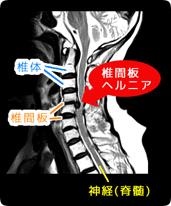 頚椎の椎間板ヘルニア