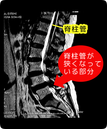 腰の脊柱管狭窄症